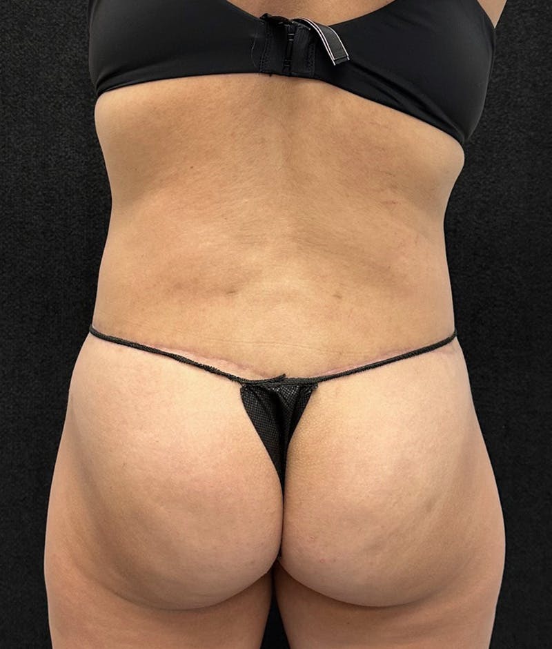 Lower Body Lift Before & After Gallery - Patient 315606 - Image 12