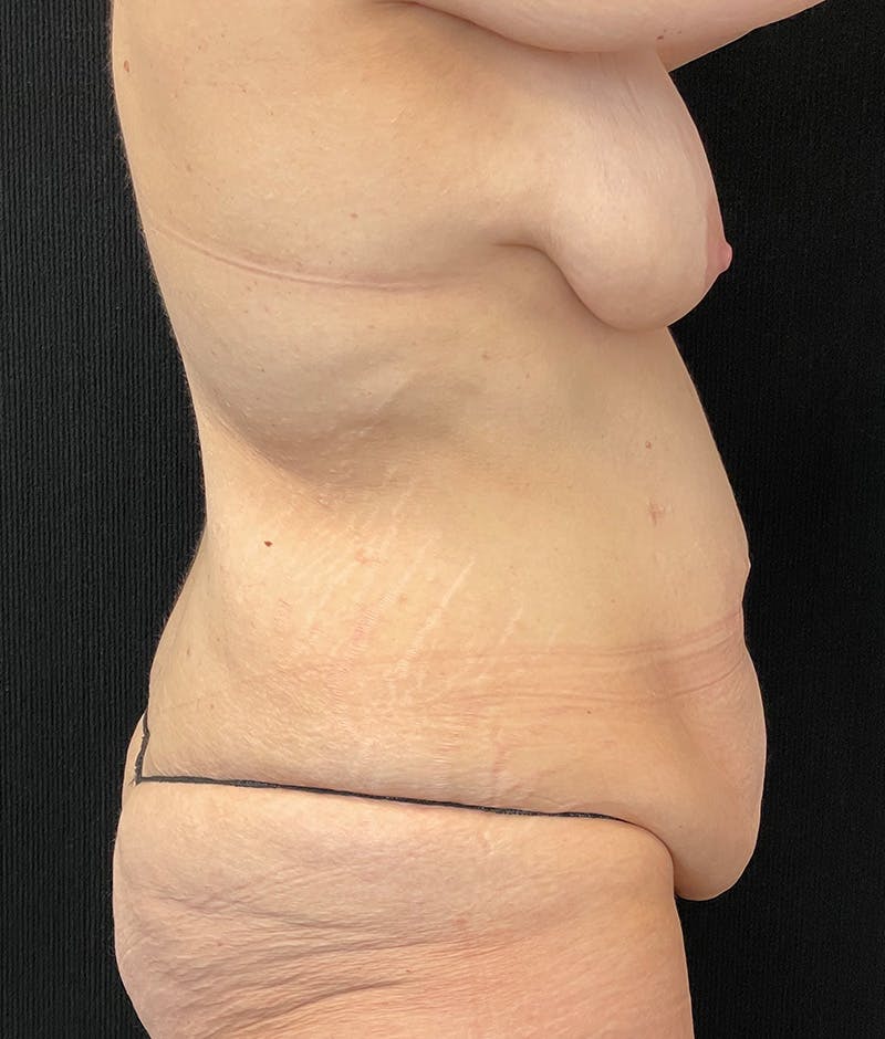 Lower Body Lift Before & After Gallery - Patient 157755 - Image 5