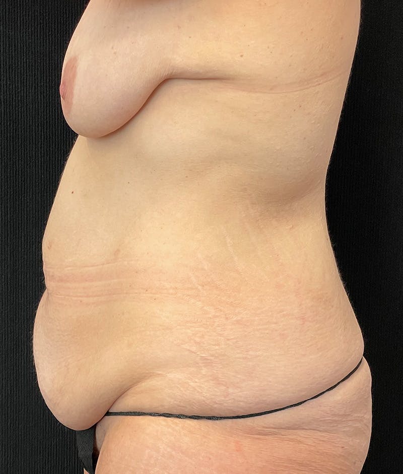 Lower Body Lift Before & After Gallery - Patient 157755 - Image 9