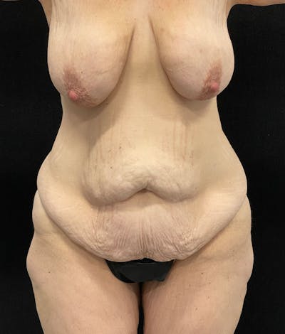Lower Body Lift Before & After Gallery - Patient 246630 - Image 1