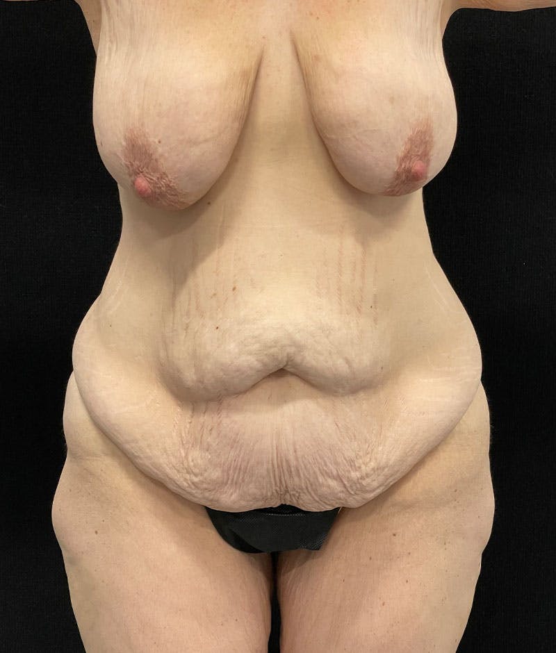 Lower Body Lift Before & After Gallery - Patient 246630 - Image 1