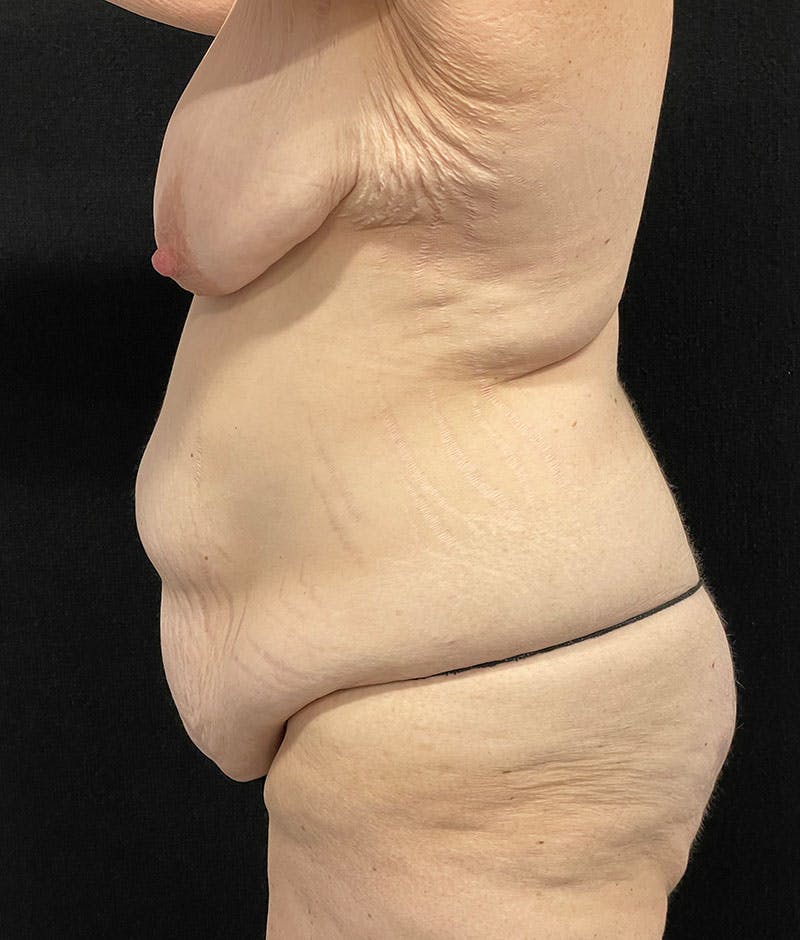 Lower Body Lift Before & After Gallery - Patient 246630 - Image 5