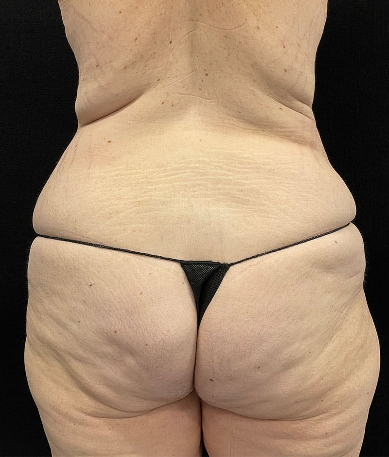 Lower Body Lift Before & After Gallery - Patient 246630 - Image 7