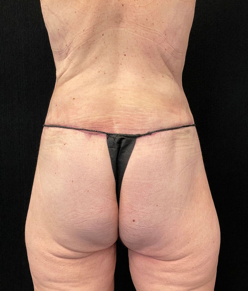 Lower Body Lift Before & After Gallery - Patient 246630 - Image 8