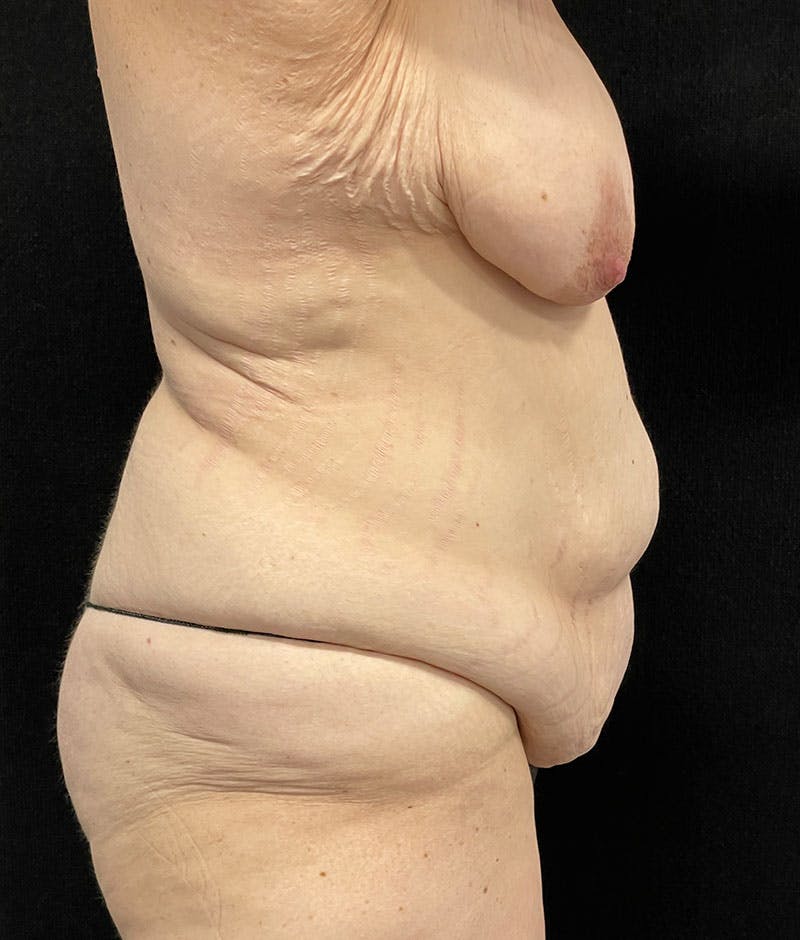 Lower Body Lift Before & After Gallery - Patient 246630 - Image 9