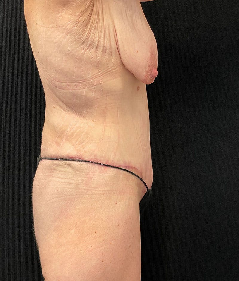 Lower Body Lift Before & After Gallery - Patient 246630 - Image 10