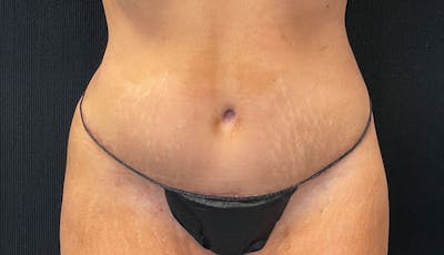 Abdominoplasty Before & After Gallery - Patient 342644 - Image 2