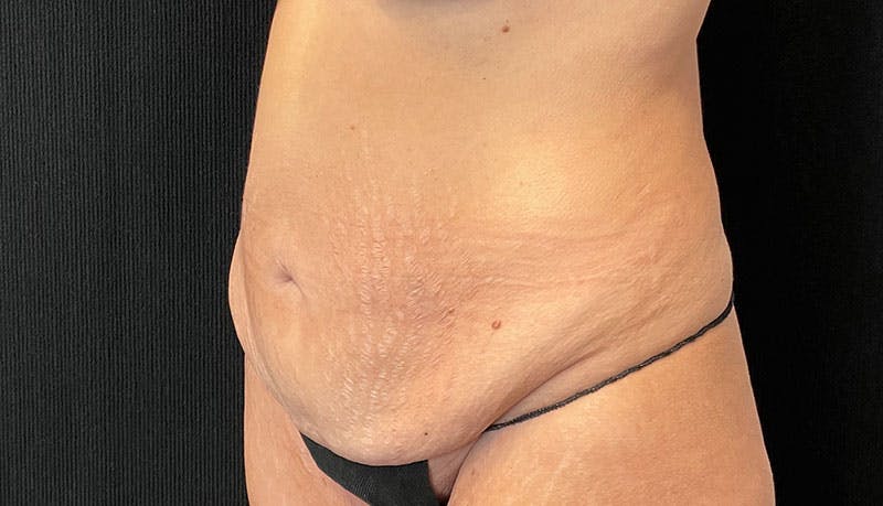 Abdominoplasty Before & After Gallery - Patient 342644 - Image 3