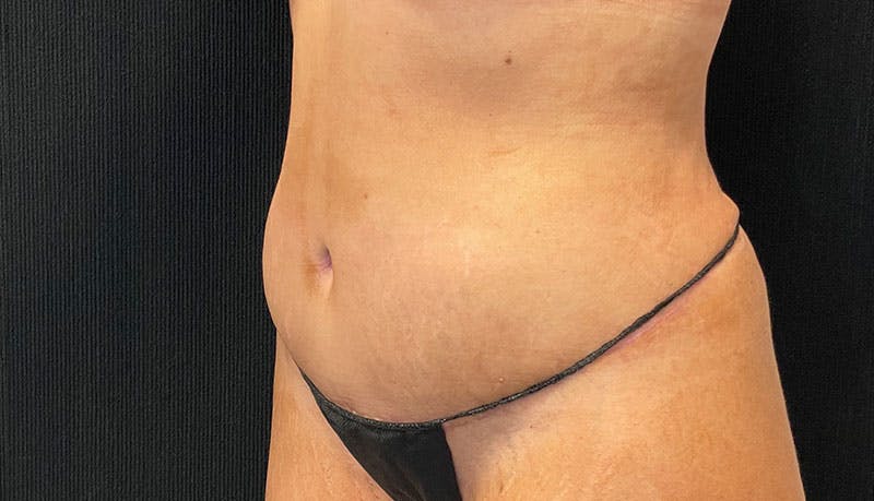 Abdominoplasty Before & After Gallery - Patient 342644 - Image 4