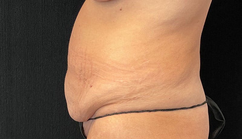 Abdominoplasty Before & After Gallery - Patient 342644 - Image 5