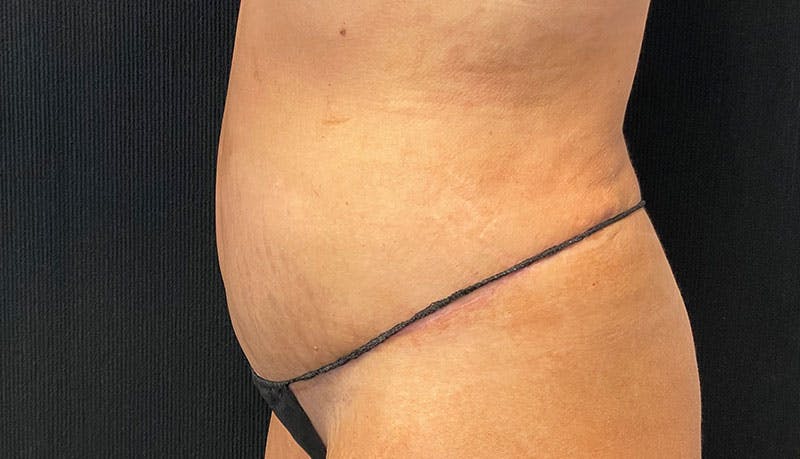 Abdominoplasty Before & After Gallery - Patient 342644 - Image 6