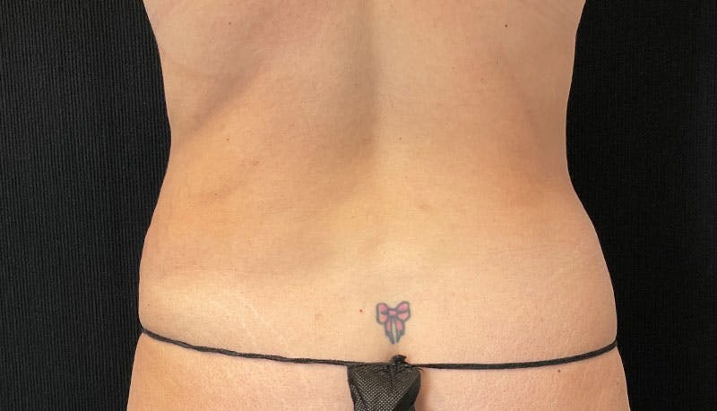 Abdominoplasty Before & After Gallery - Patient 342644 - Image 7