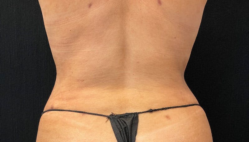 Abdominoplasty Before & After Gallery - Patient 342644 - Image 8