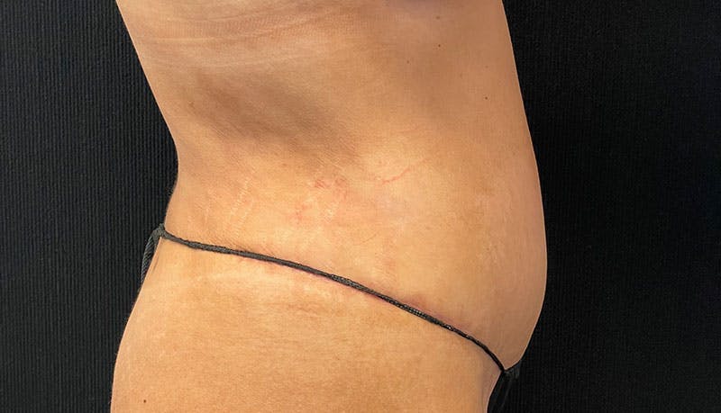 Abdominoplasty Before & After Gallery - Patient 342644 - Image 12