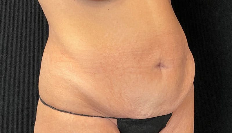 Abdominoplasty Before & After Gallery - Patient 342644 - Image 9
