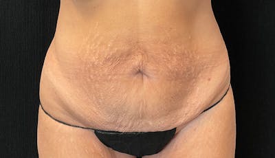 Abdominoplasty Before & After Gallery - Patient 342644 - Image 1