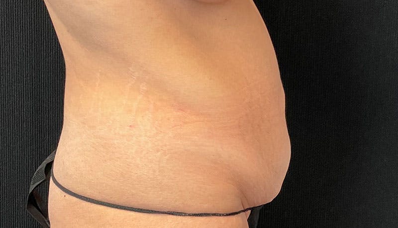 Abdominoplasty Before & After Gallery - Patient 342644 - Image 11