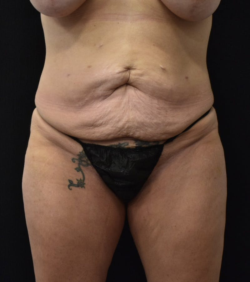 Lower Body Lift Before & After Gallery - Patient 248161 - Image 1