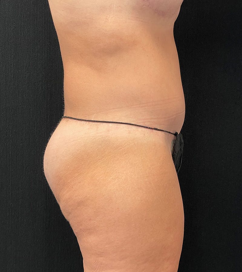 Lower Body Lift Before & After Gallery - Patient 248161 - Image 6