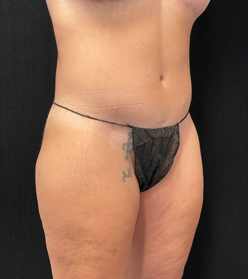 Lower Body Lift Before & After Gallery - Patient 248161 - Image 4