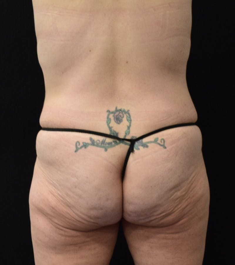 Lower Body Lift Before & After Gallery - Patient 248161 - Image 9