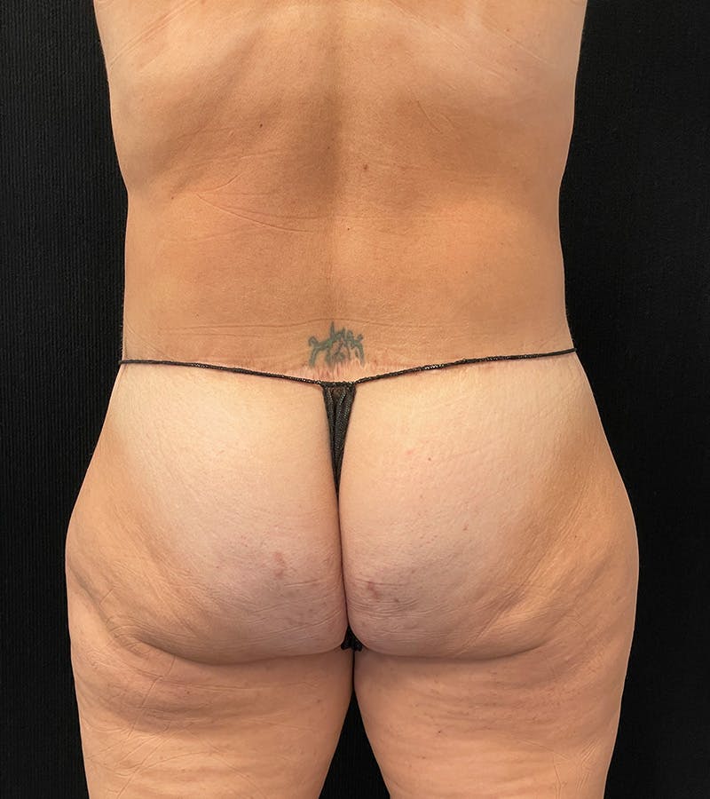Lower Body Lift Before & After Gallery - Patient 248161 - Image 10