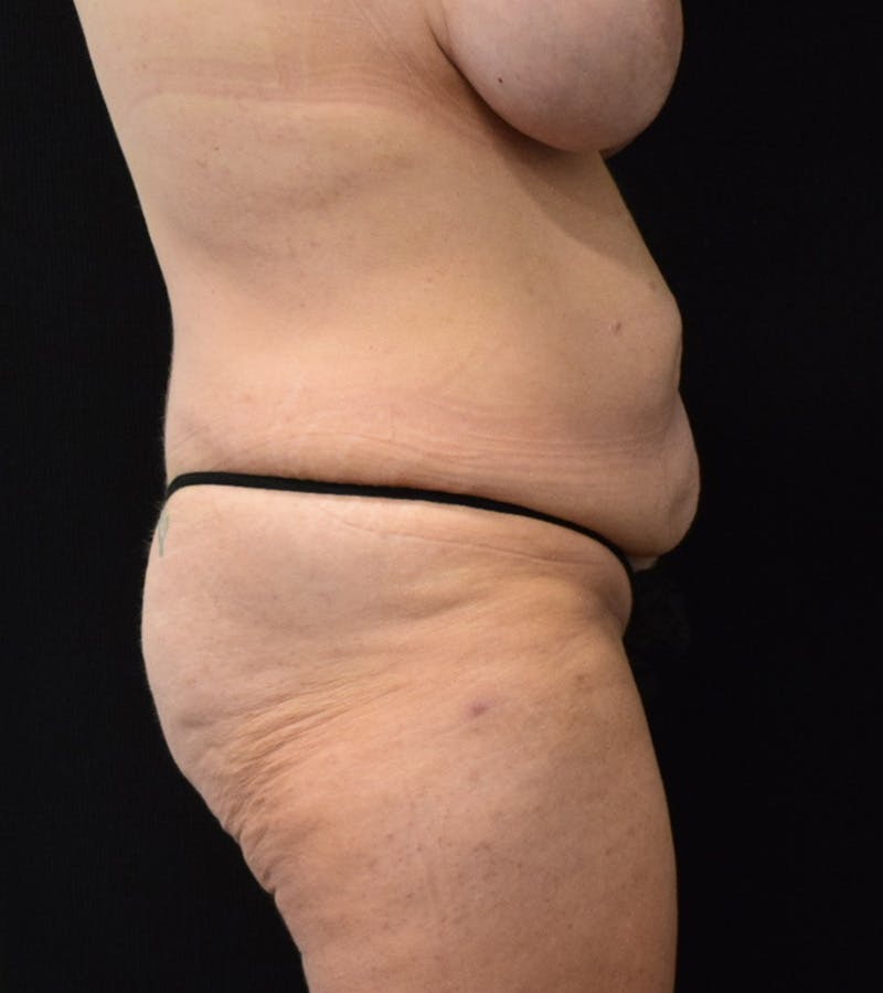 Lower Body Lift Before & After Gallery - Patient 248161 - Image 5