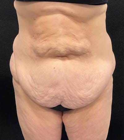 Lower Body Lift Before & After Gallery - Patient 424973 - Image 1