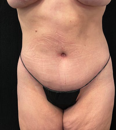 Lower Body Lift Before & After Gallery - Patient 424973 - Image 2