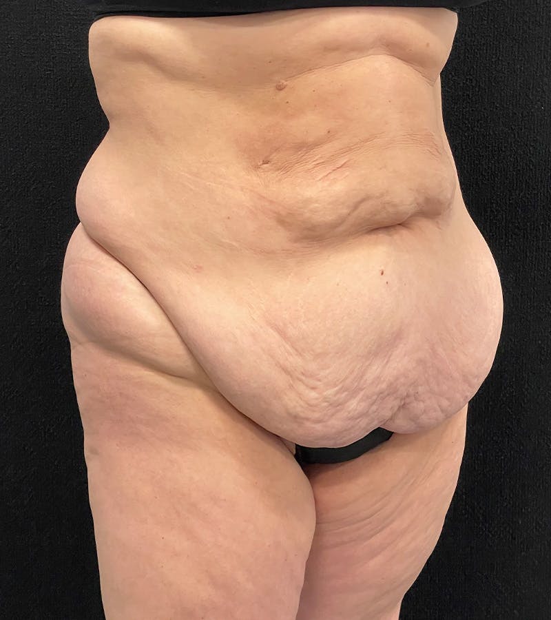 Lower Body Lift Before & After Gallery - Patient 424973 - Image 3
