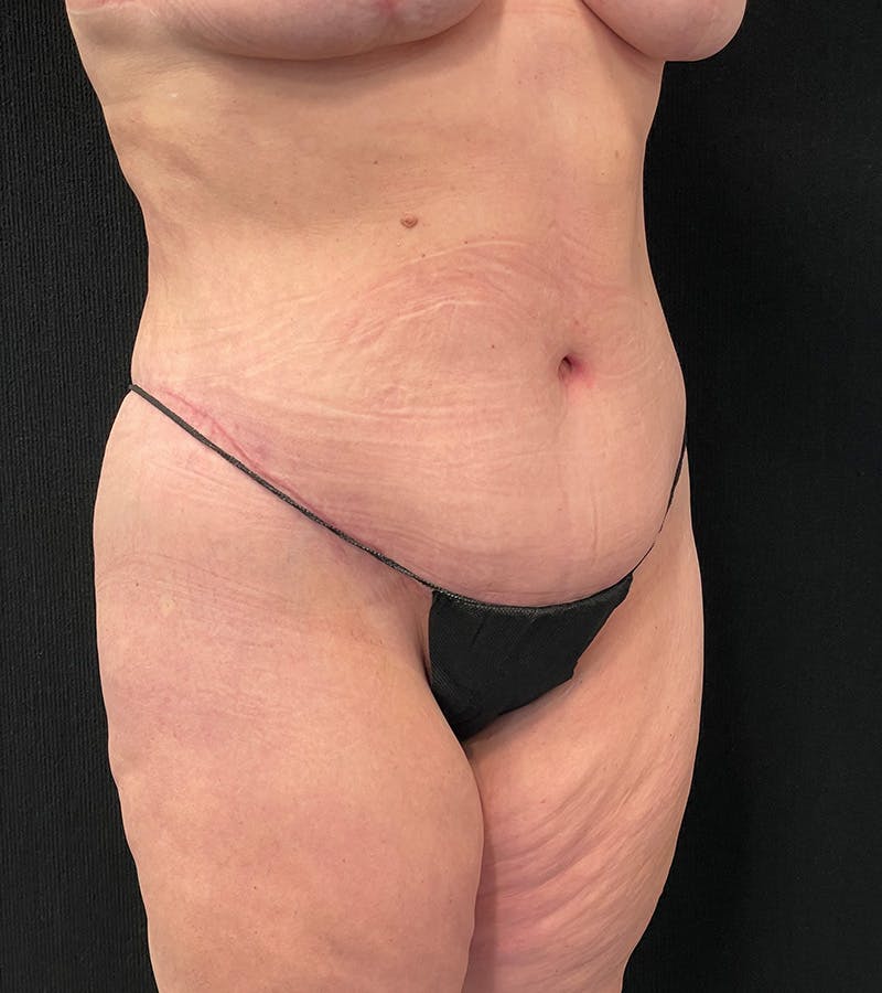 Lower Body Lift Before & After Gallery - Patient 424973 - Image 4