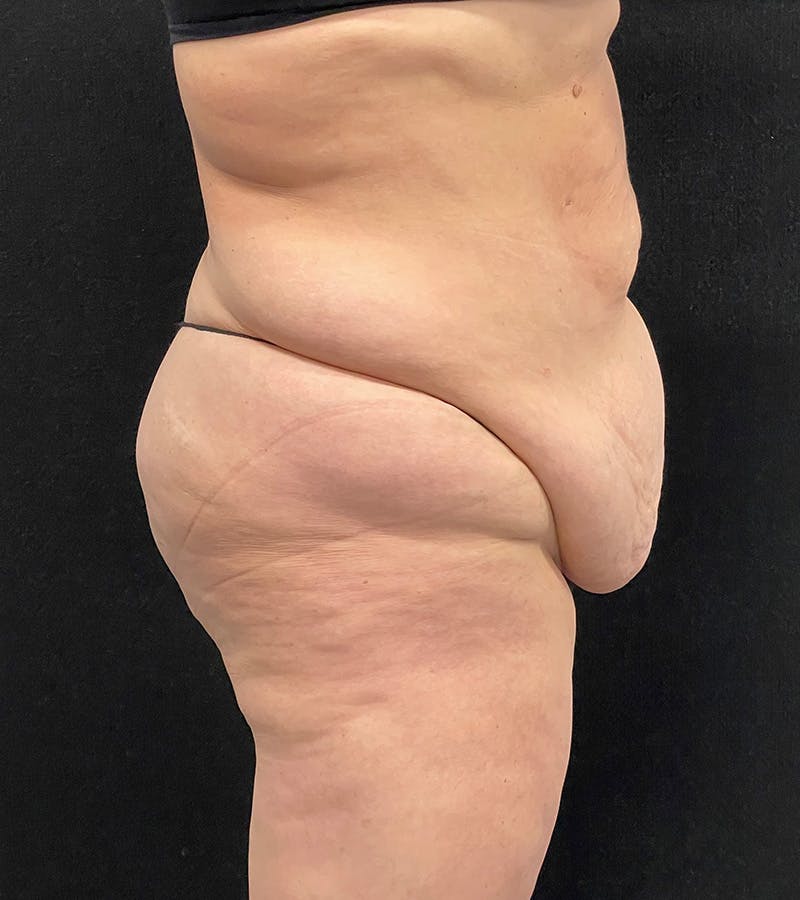 Lower Body Lift Before & After Gallery - Patient 424973 - Image 5