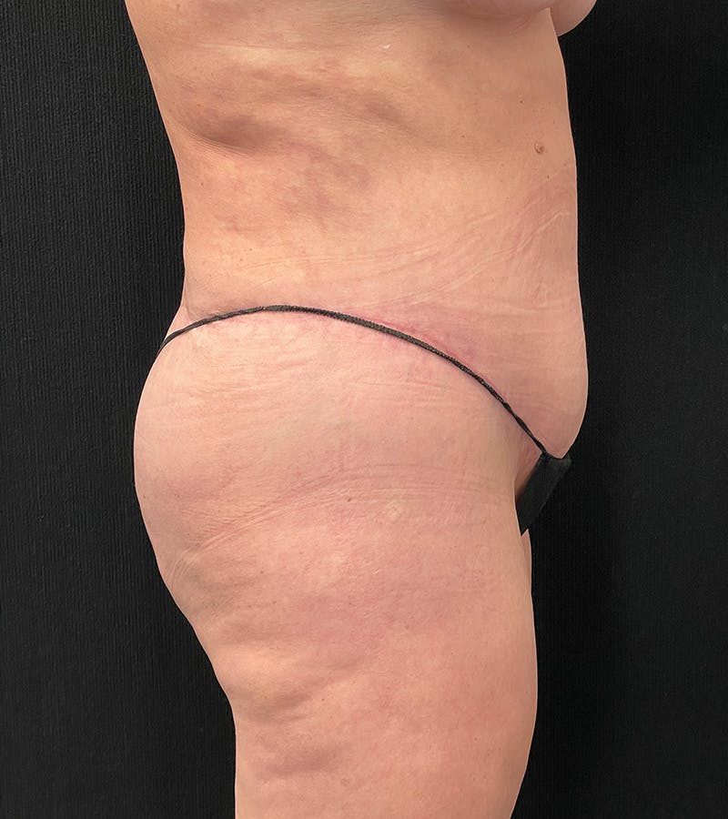 Lower Body Lift Before & After Gallery - Patient 424973 - Image 6