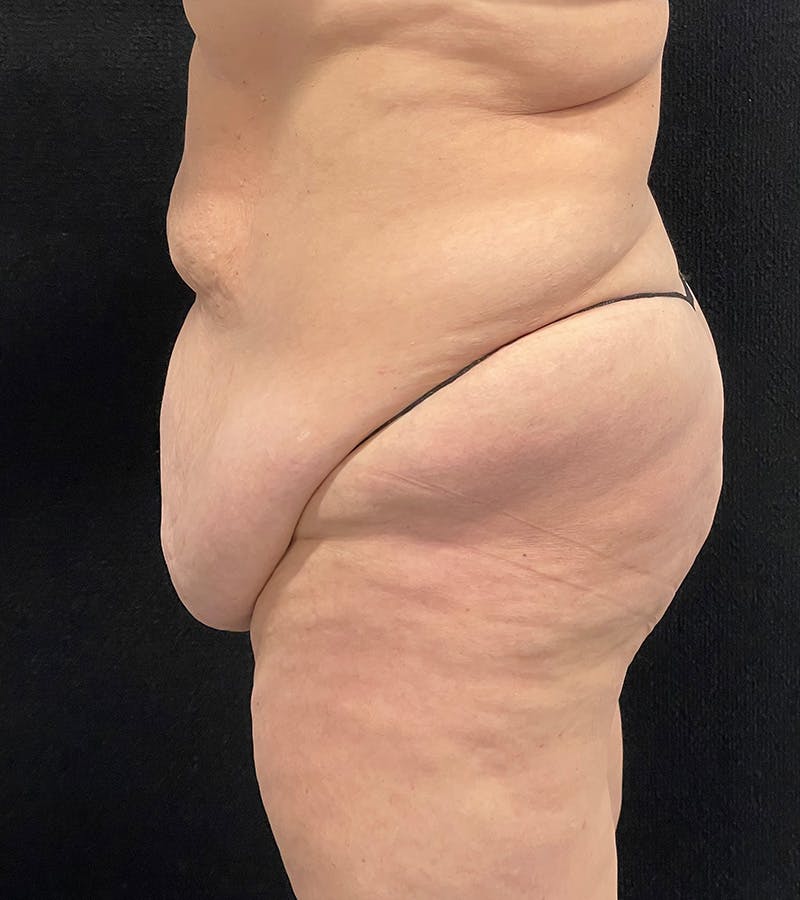 Lower Body Lift Before & After Gallery - Patient 424973 - Image 9