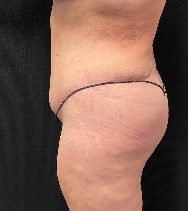 Lower Body Lift Before & After Gallery - Patient 424973 - Image 10