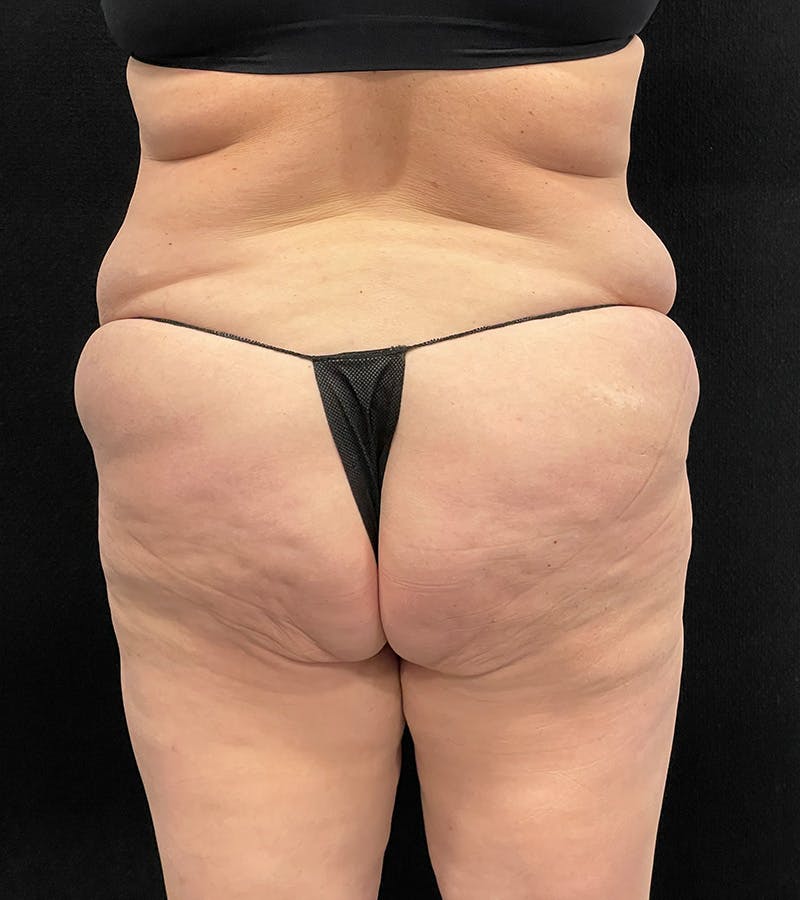 Lower Body Lift Before & After Gallery - Patient 424973 - Image 11