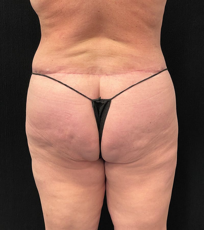 Lower Body Lift Before & After Gallery - Patient 424973 - Image 12