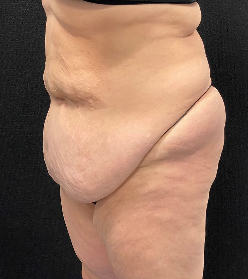 Lower Body Lift Before & After Gallery - Patient 424973 - Image 7