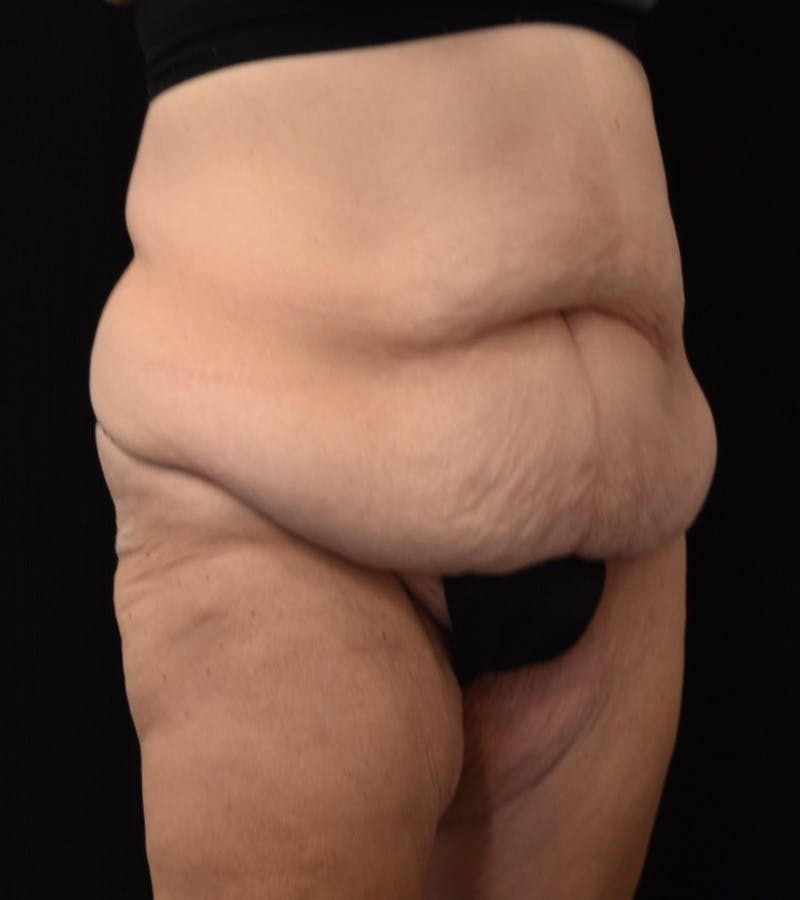 Lower Body Lift Before & After Gallery - Patient 338976 - Image 3