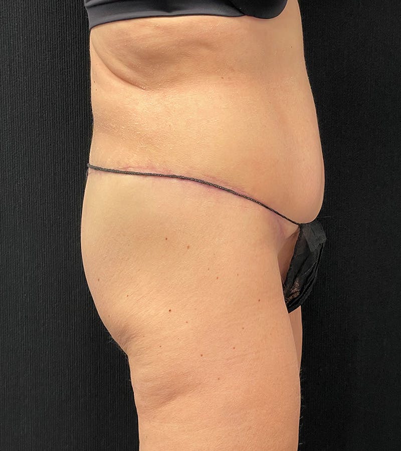 Lower Body Lift Before & After Gallery - Patient 338976 - Image 6
