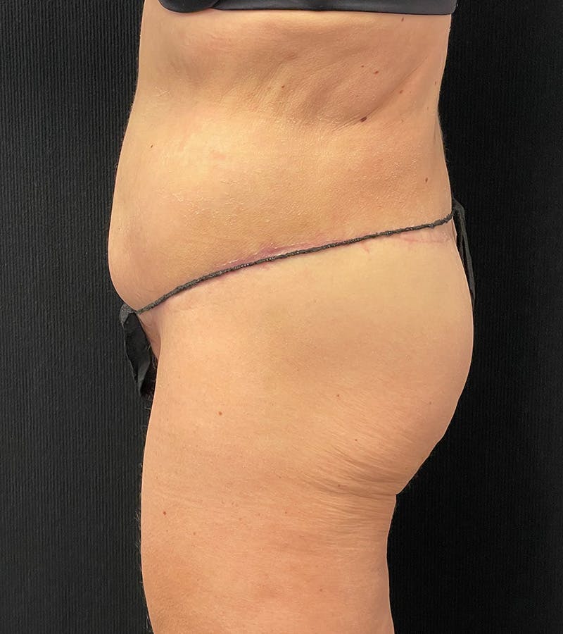 Lower Body Lift Before & After Gallery - Patient 338976 - Image 10