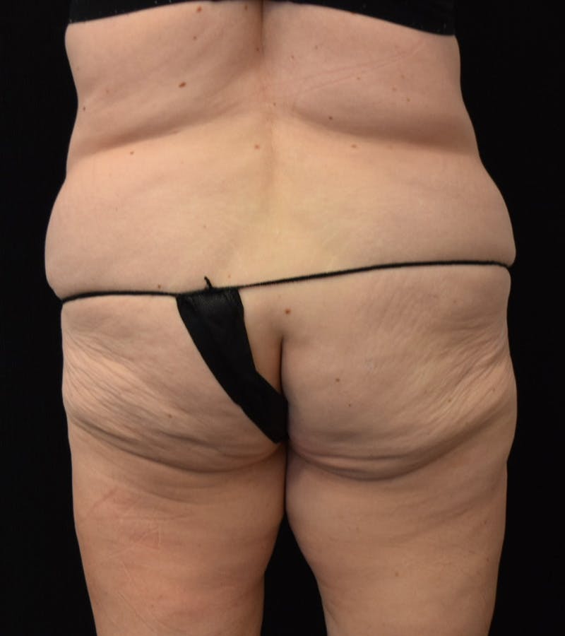Lower Body Lift Before & After Gallery - Patient 338976 - Image 11
