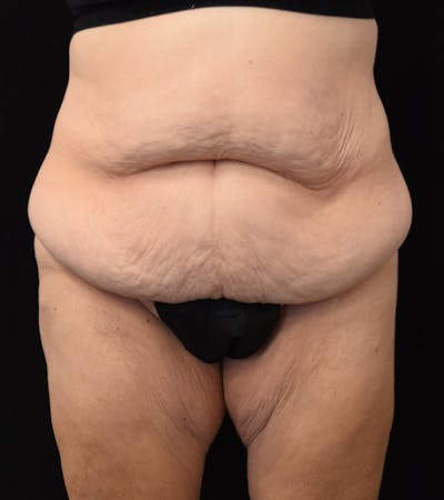 Lower Body Lift Before & After Gallery - Patient 338976 - Image 1