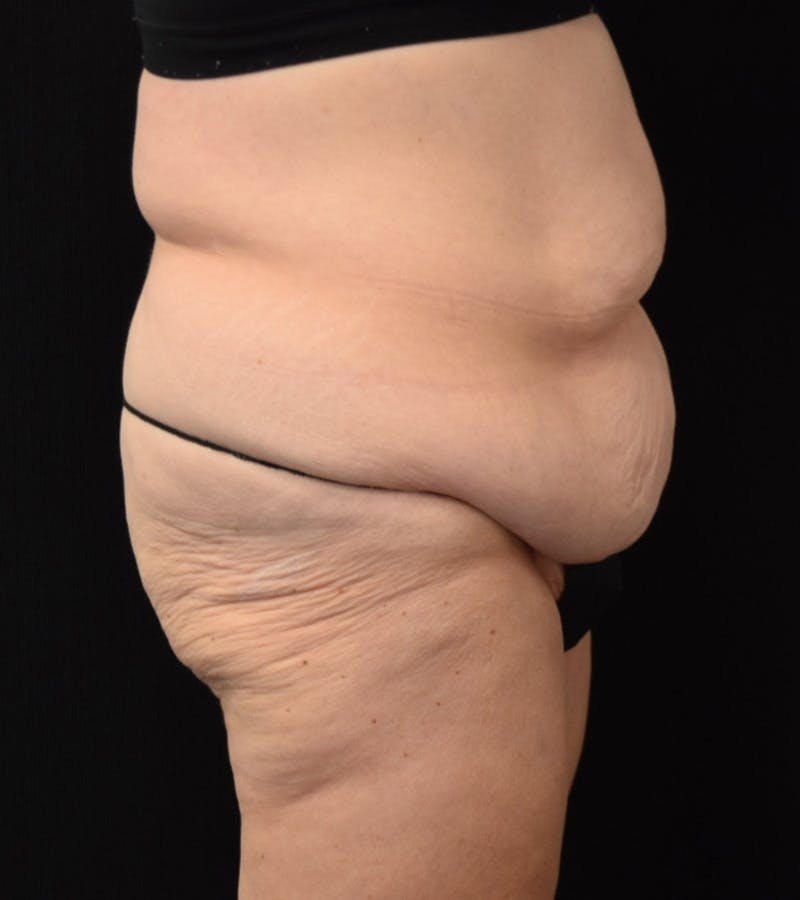Lower Body Lift Before & After Gallery - Patient 338976 - Image 5