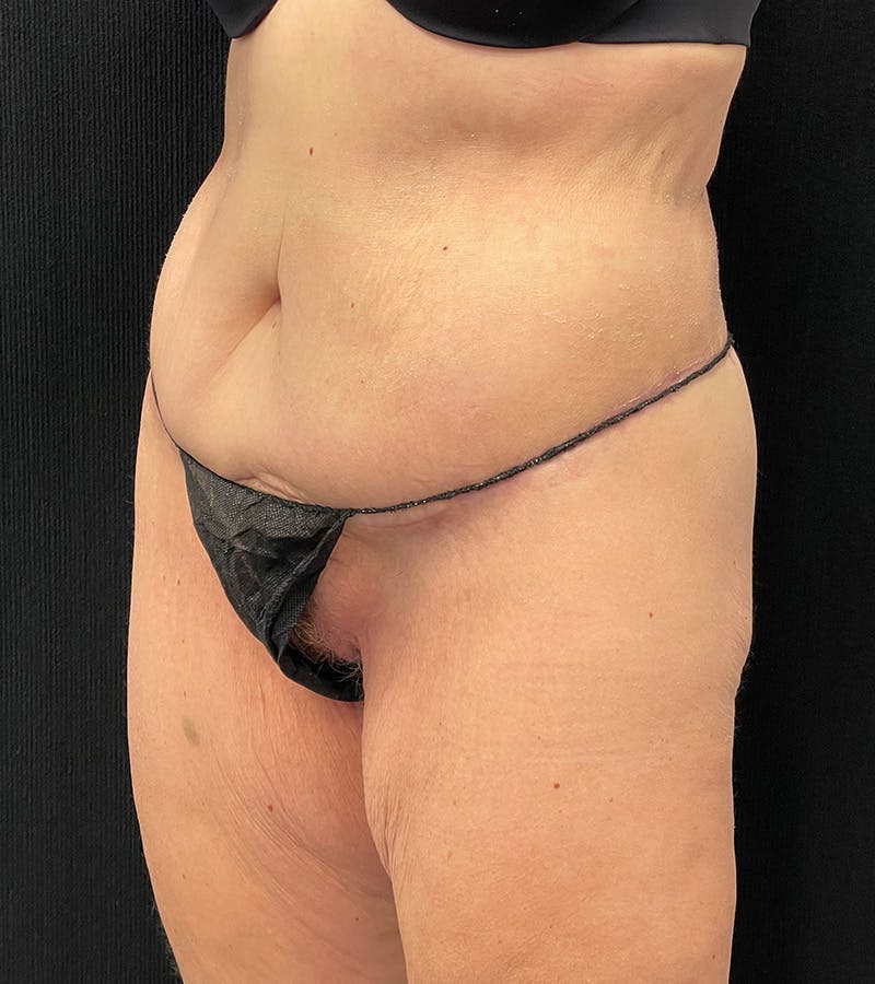 Lower Body Lift Before & After Gallery - Patient 338976 - Image 8