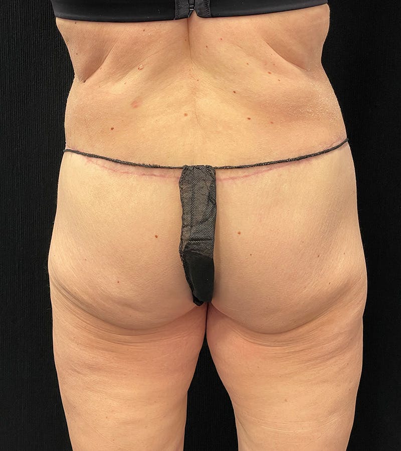 Lower Body Lift Before & After Gallery - Patient 338976 - Image 12