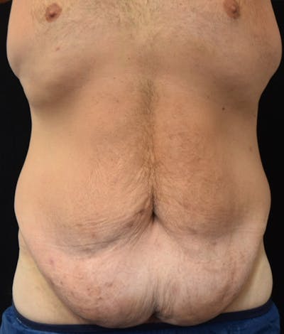 Male Lower Body Lift Before & After Gallery - Patient 376758 - Image 1