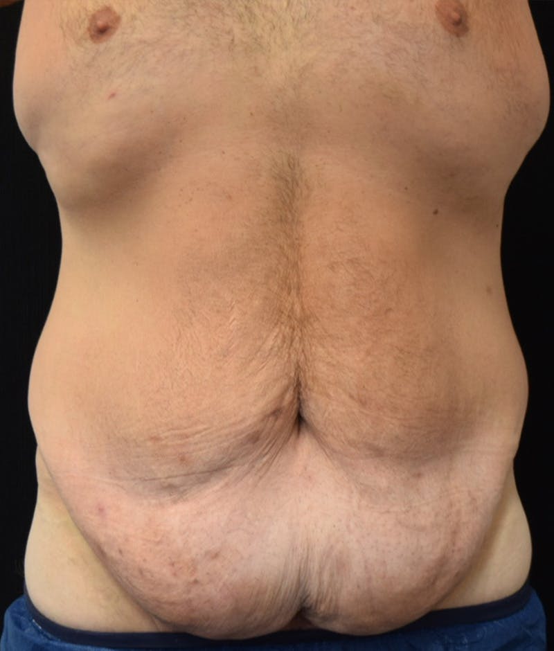 Male Lower Body Lift Before & After Gallery - Patient 376758 - Image 1