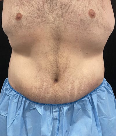 Male Lower Body Lift Before & After Gallery - Patient 376758 - Image 2