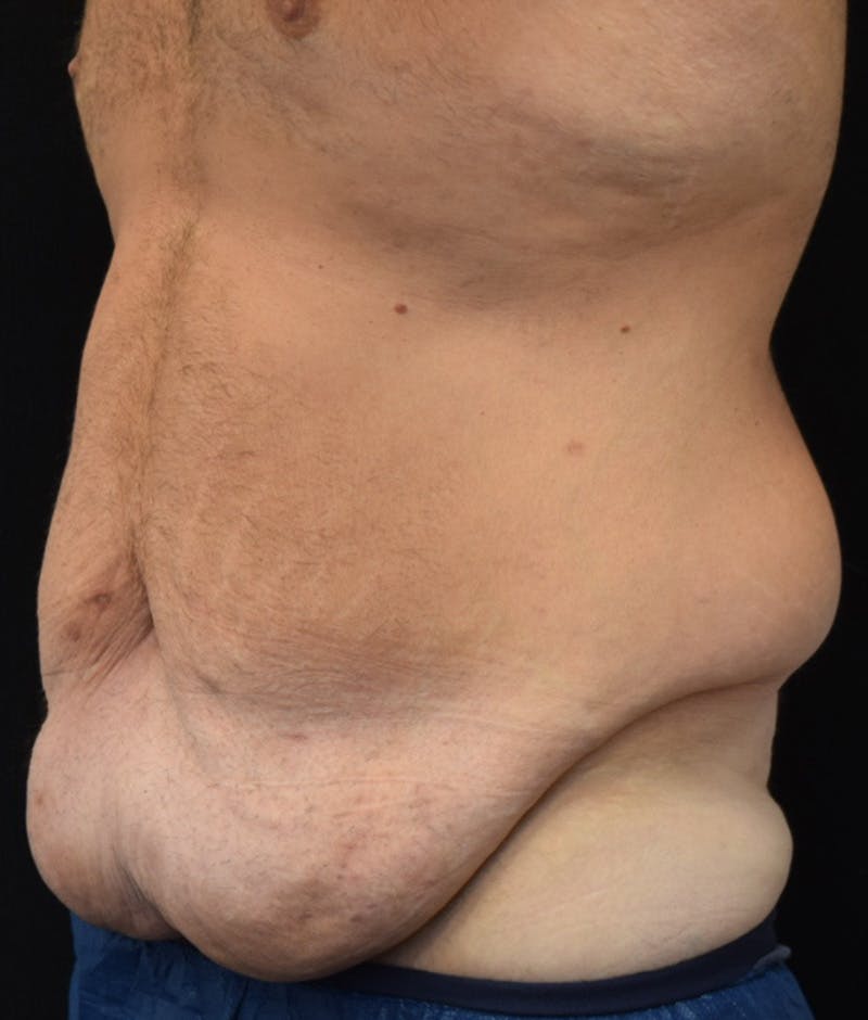 Male Lower Body Lift Before & After Gallery - Patient 376758 - Image 3